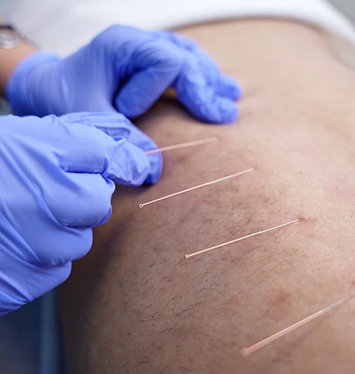 Acupuncture in Vancouver