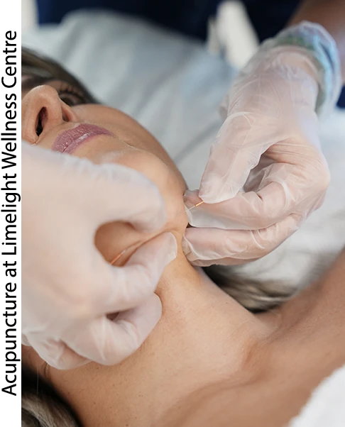 Acupuncture in Vancouver