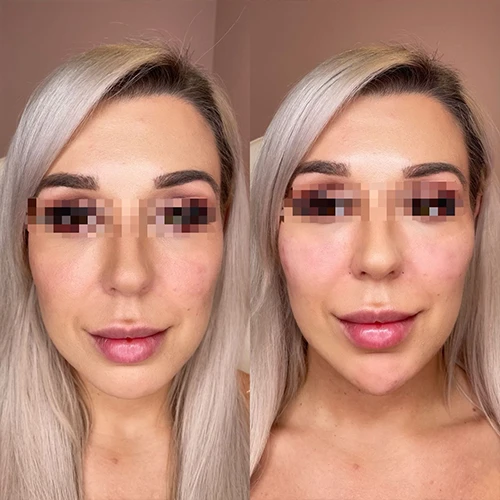 Botox in Vancouver