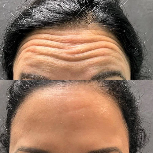 Botox in Vancouver