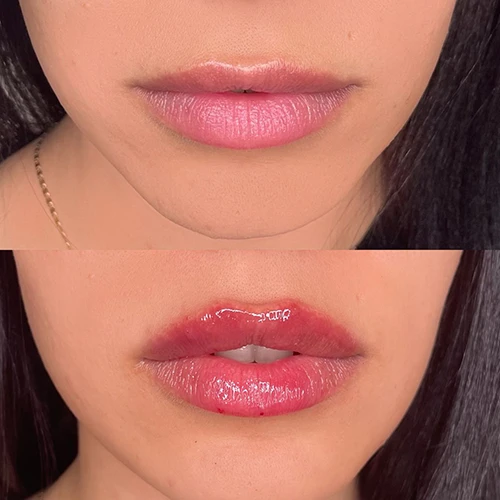 Botox in Vancouver
