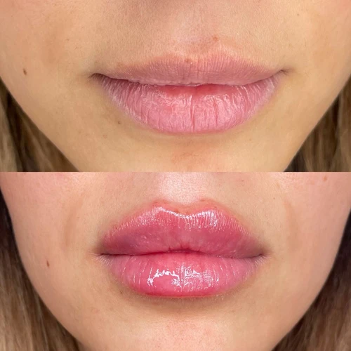 Botox in Vancouver