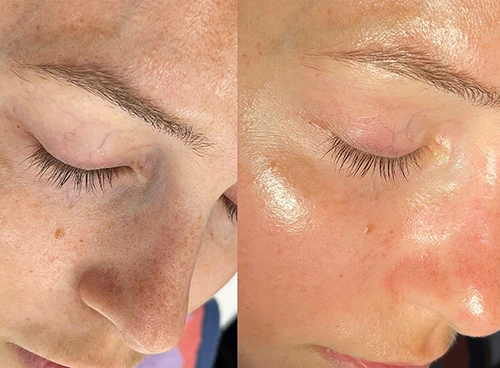 HydraFacial in Vancouver