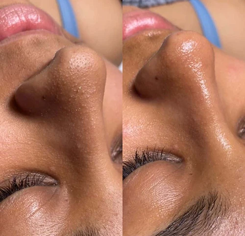 HydraFacial in Vancouver