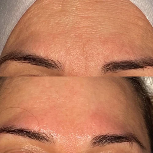 HydraFacial in Vancouver
