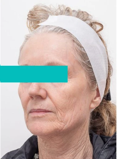 Hyperpigmentation Treatment Hyperpigmentation Treatment