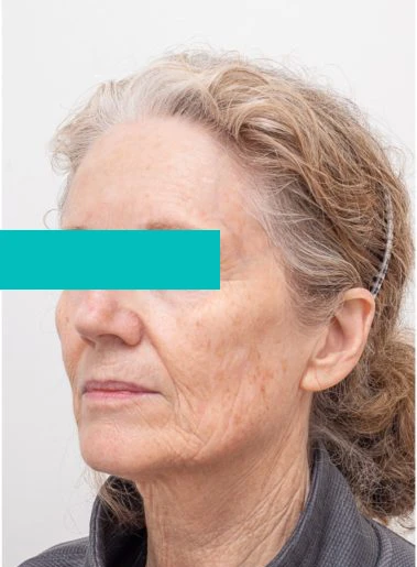 Hyperpigmentation Treatment Hyperpigmentation Treatment