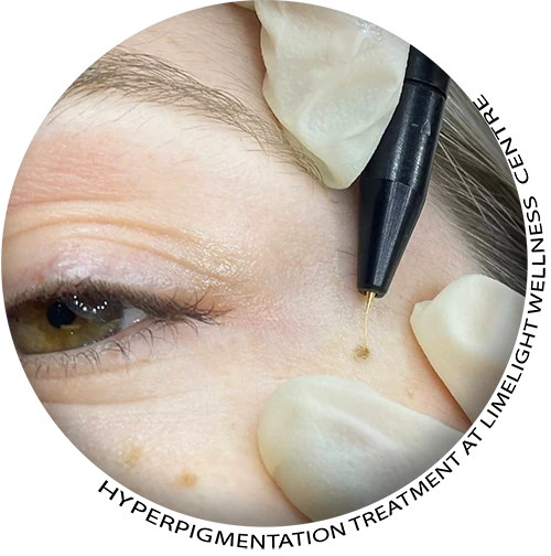 Hyperpigmentation Treatment