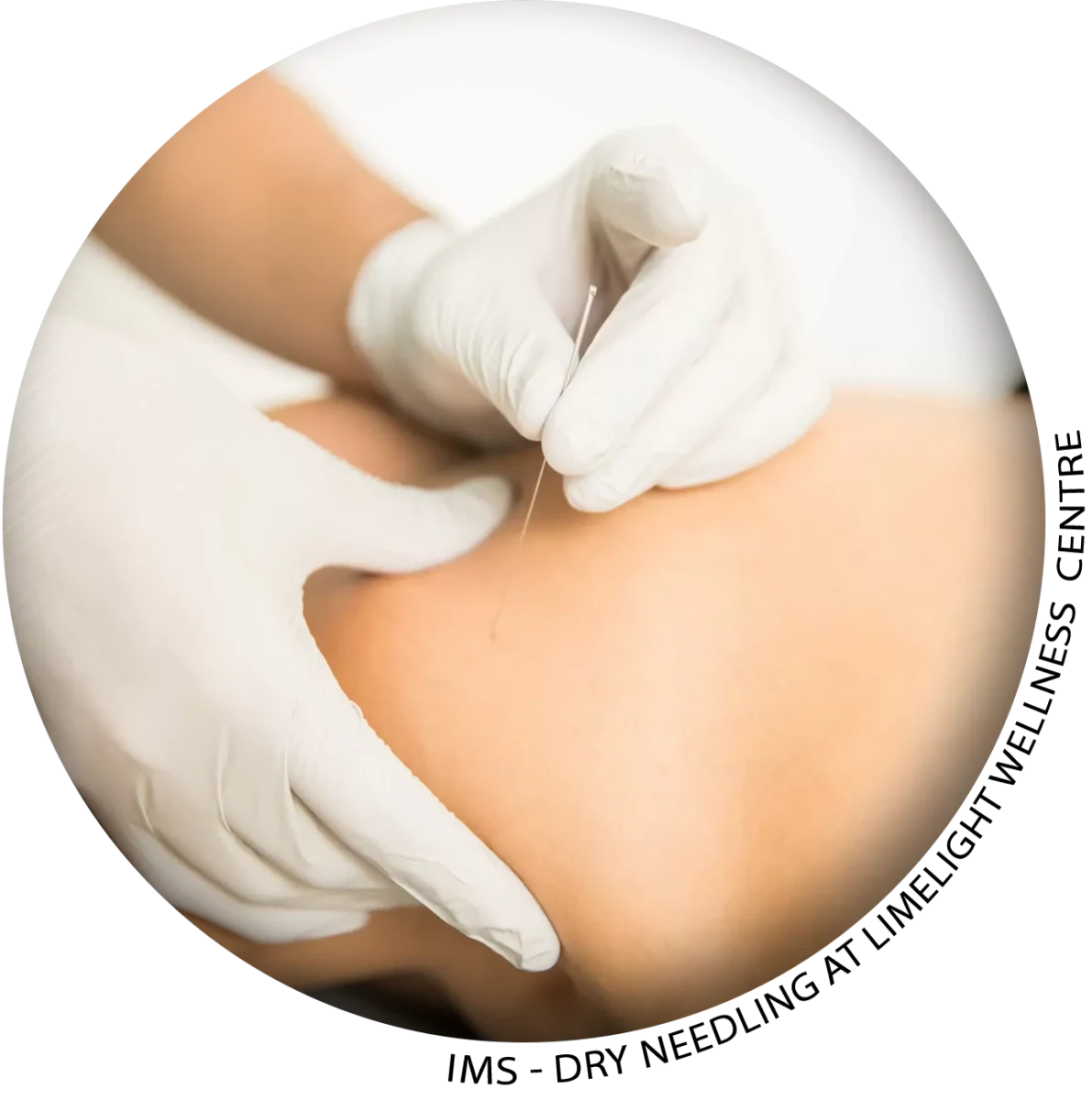 IMS Therapy in Vancouver