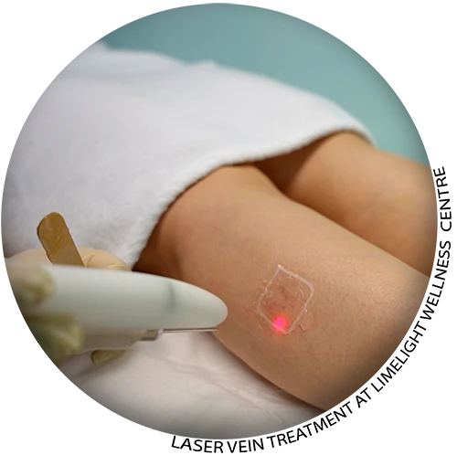 Vein Treatment in Vancouver