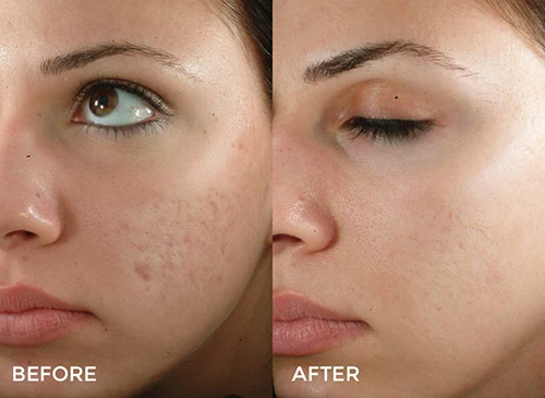 Microdermabrasion in Vancouver