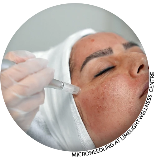 Microneedling in Vancouver