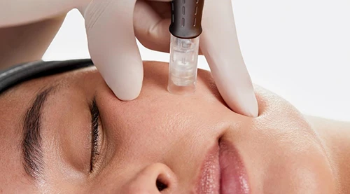 Microneedling in Vancouver