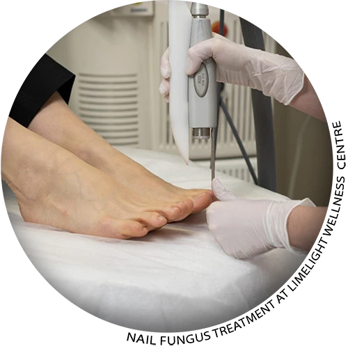 Nail Fungus Treatment