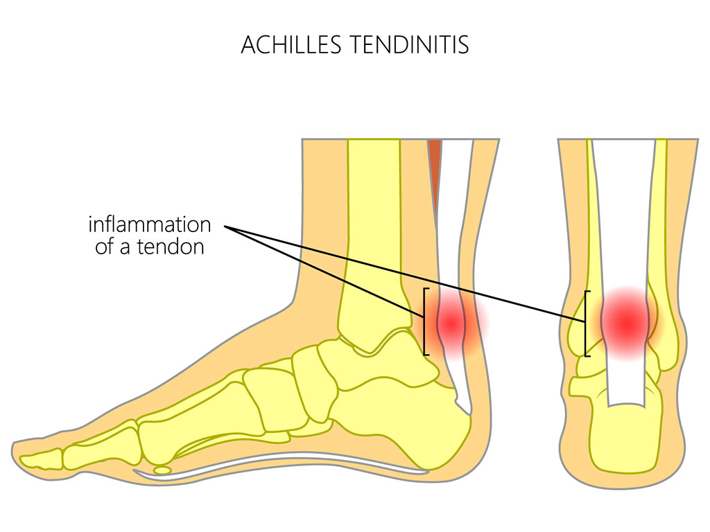 Ankle and Foot Therapy