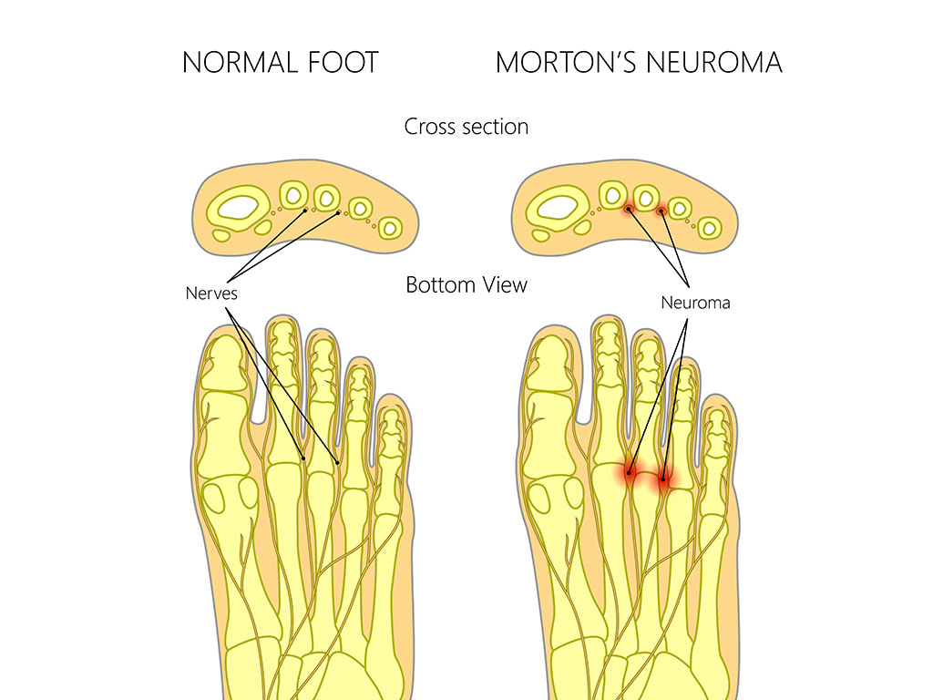 Ankle and Foot Therapy