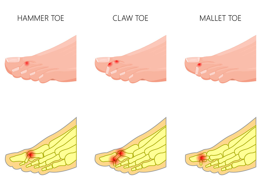 Ankle and Foot Therapy