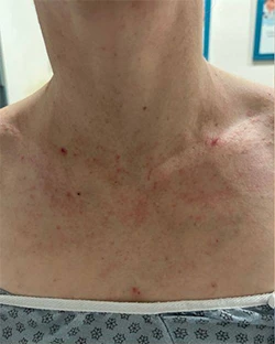 Acupuncture in Vancouver Acupuncture in Vancouver