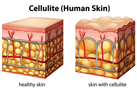 Cellulite Therapy in Vancouver