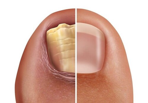 Nail Fungus Treatment