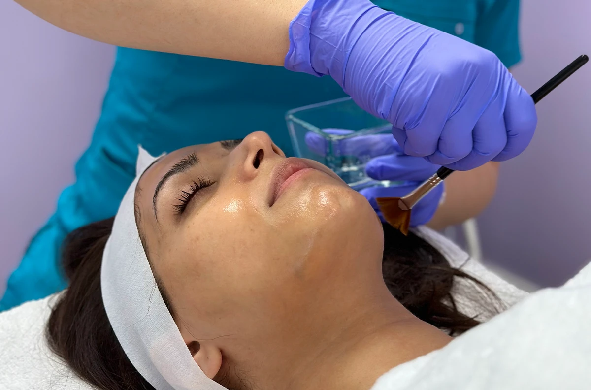 Chemical Peels in Vancouver