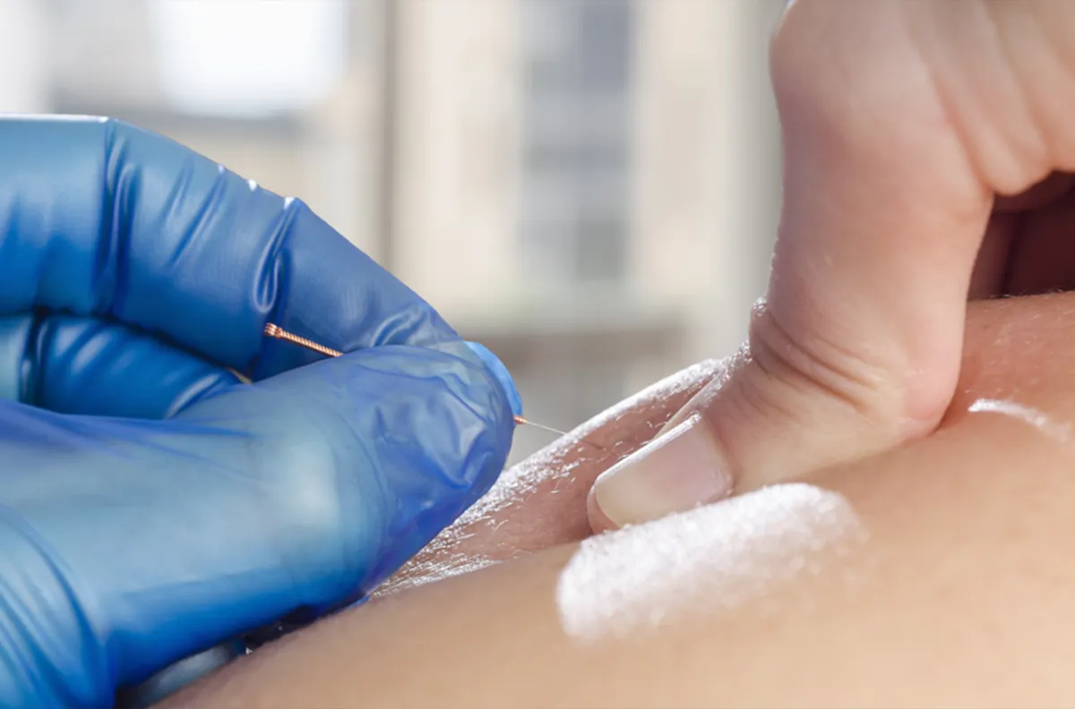 Different Kinds of Acupuncture Techniques