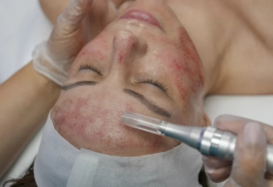 Microneedling in Vancouver: Boost Your Skin’s Natural Glow Best microneedling clinic Vancouver at limelight Wellness Centre