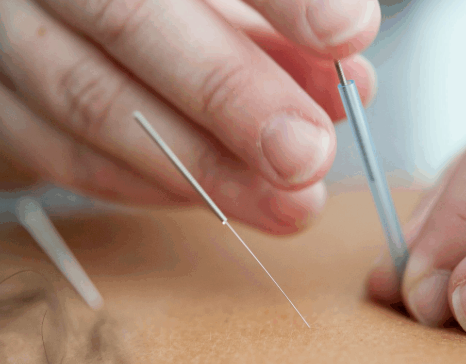 Discover Acupuncture: Myths, Realities & Wellness in Vancouver