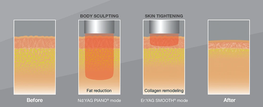 Body Contouring