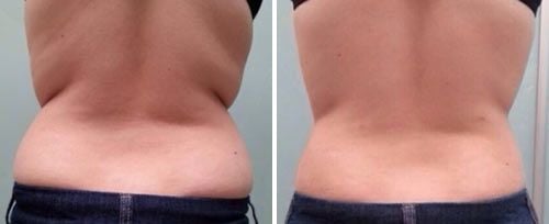 Body Contouring