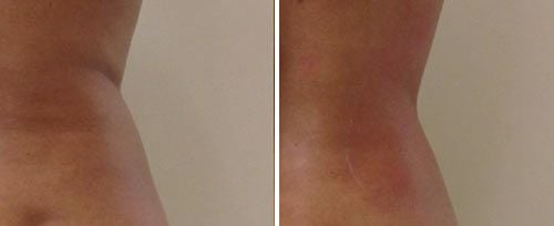 Body Contouring