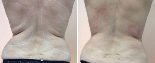 Body Contouring